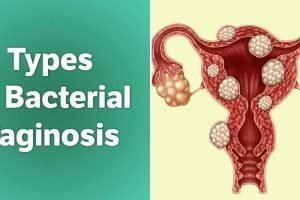 Know if you’ve got a case of bacterial vaginosis